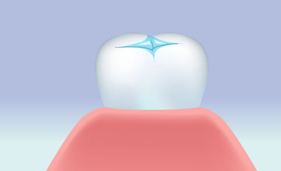 シーラント